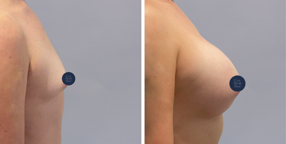 Breast Augmentation boob job before and after photo