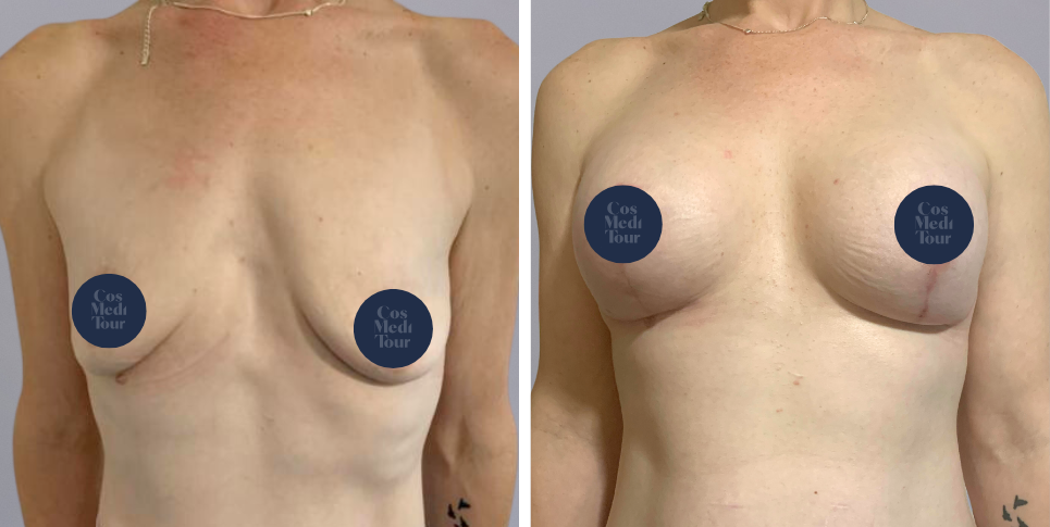 Breast Augmentation and breast lift breast augmentation plus lift boob job before and after photo