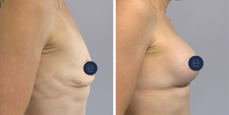 Breast Augmentation and breast lift breast augmentation plus lift boob job before and after photo