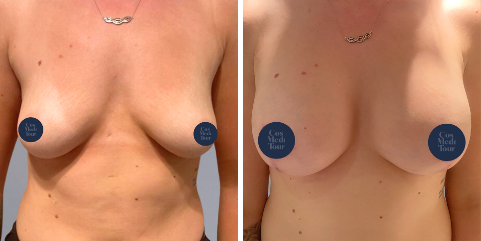 Breast Augmentation and breast lift breast augmentation plus lift boob job before and after photo