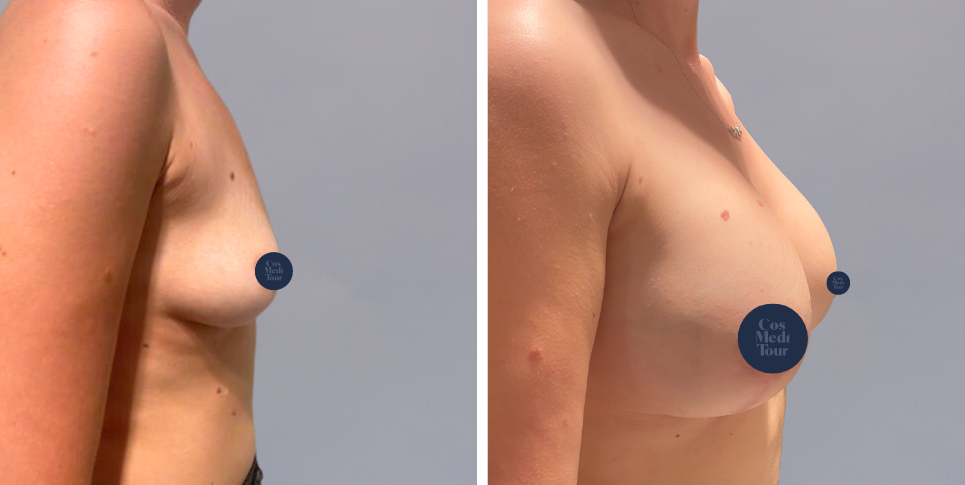 Breast Augmentation and breast lift breast augmentation plus lift boob job before and after photo