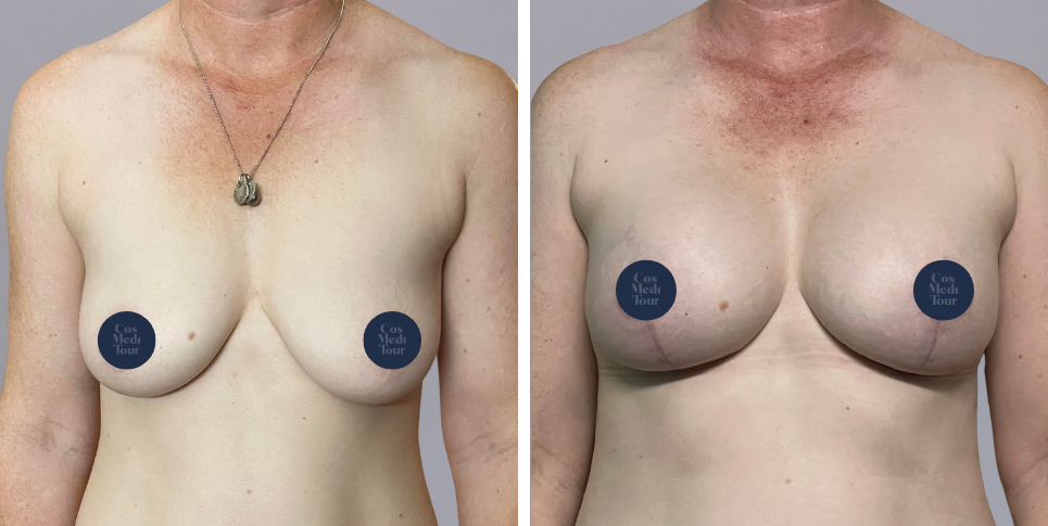 Breast Augmentation and breast lift breast augmentation plus lift boob job before and after photo