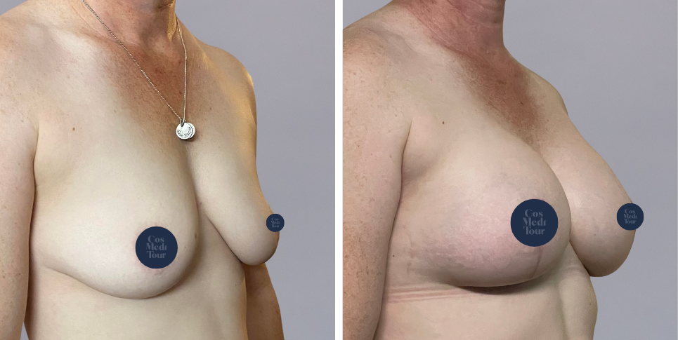 Breast Augmentation and breast lift breast augmentation plus lift boob job before and after photo