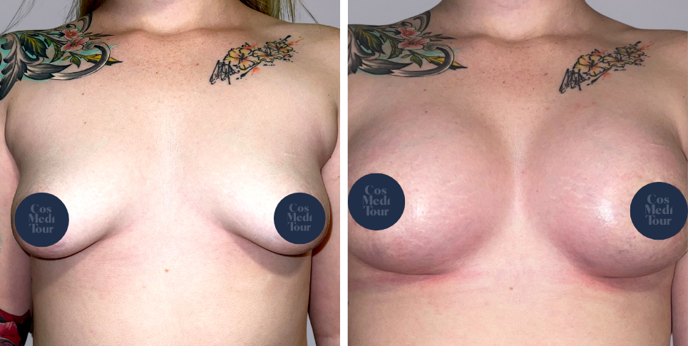 Breast Augmentation and breast lift breast augmentation plus lift boob job before and after photo