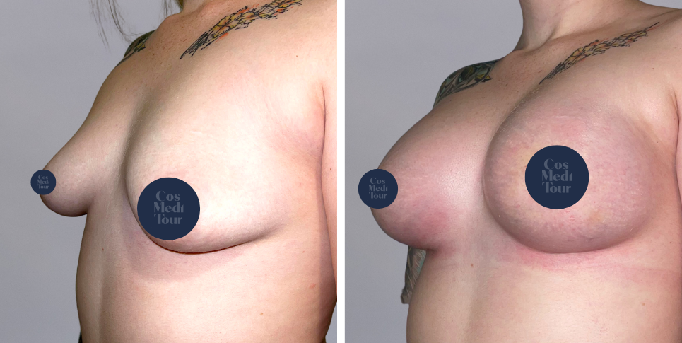 Breast Augmentation and breast lift breast augmentation plus lift boob job before and after photo