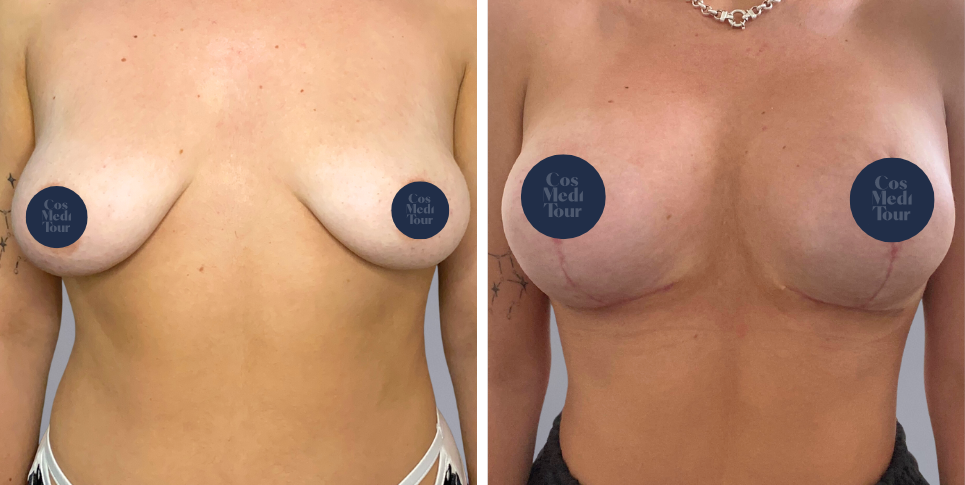 Breast Augmentation and breast lift breast augmentation plus lift boob job before and after photo