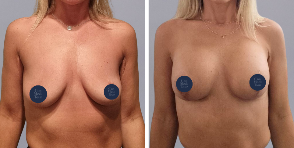 Breast Augmentation and breast lift breast augmentation plus lift boob job before and after photo