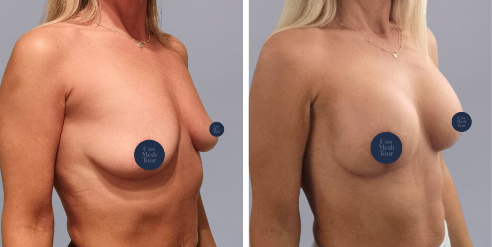 Breast Augmentation and breast lift breast augmentation plus lift boob job before and after photo