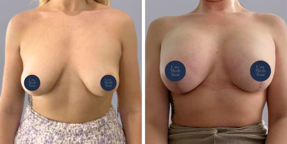 Breast Augmentation and breast lift breast augmentation plus lift boob job before and after photo