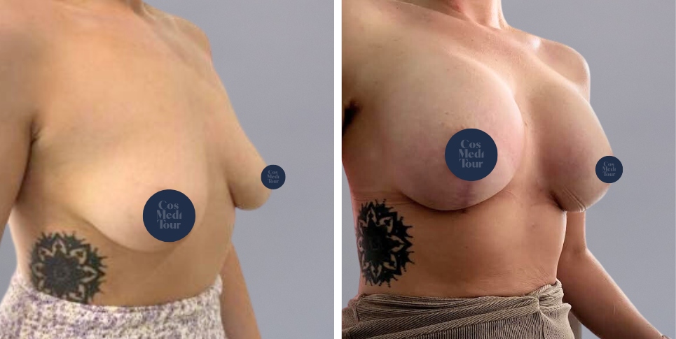 Breast Augmentation and breast lift breast augmentation plus lift boob job before and after photo