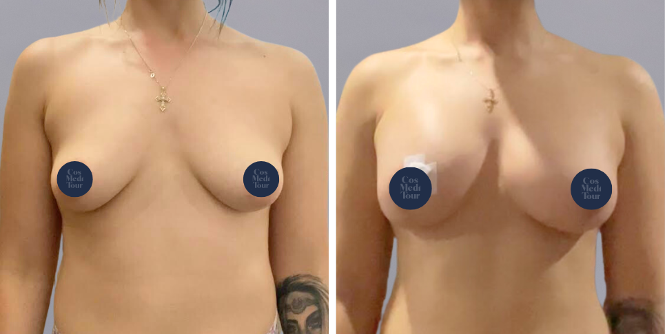 Breast Augmentation and breast lift breast augmentation plus lift boob job before and after photo