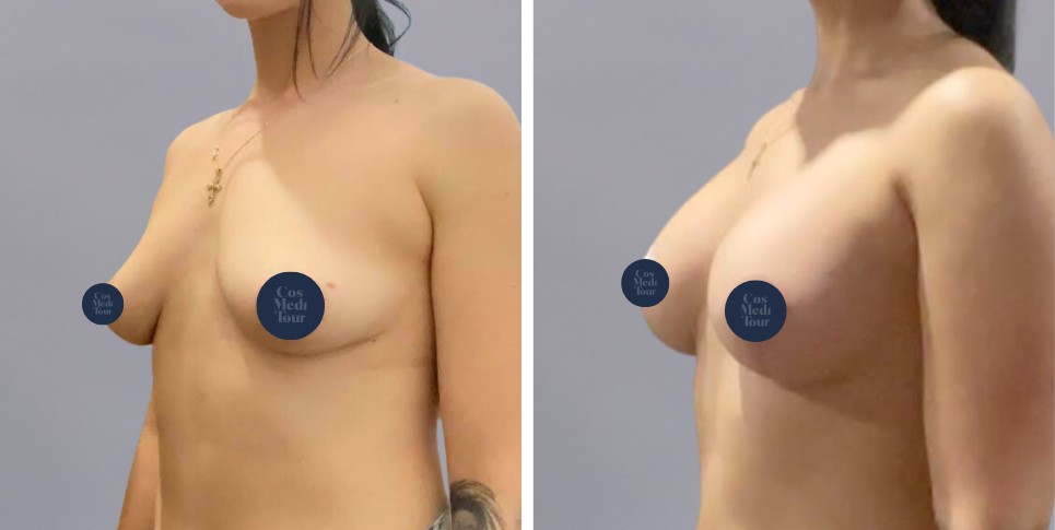 Breast Augmentation and breast lift breast augmentation plus lift boob job before and after photo