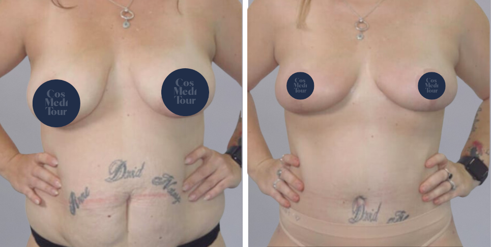 Breast Lift boob job before and after photo