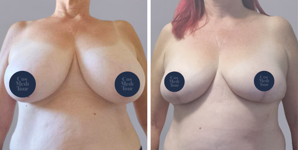 Breast Lift boob job before and after photo
