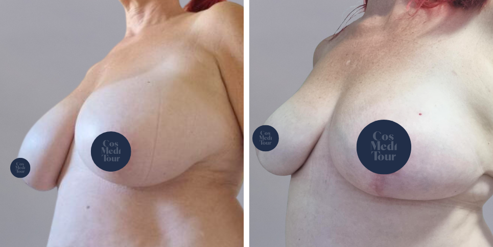 Breast Lift boob job before and after photo
