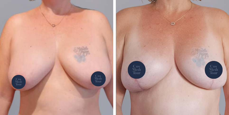 Breast Lift boob job before and after photo
