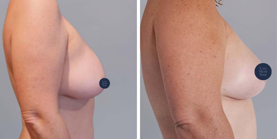 Breast Lift boob job before and after photo
