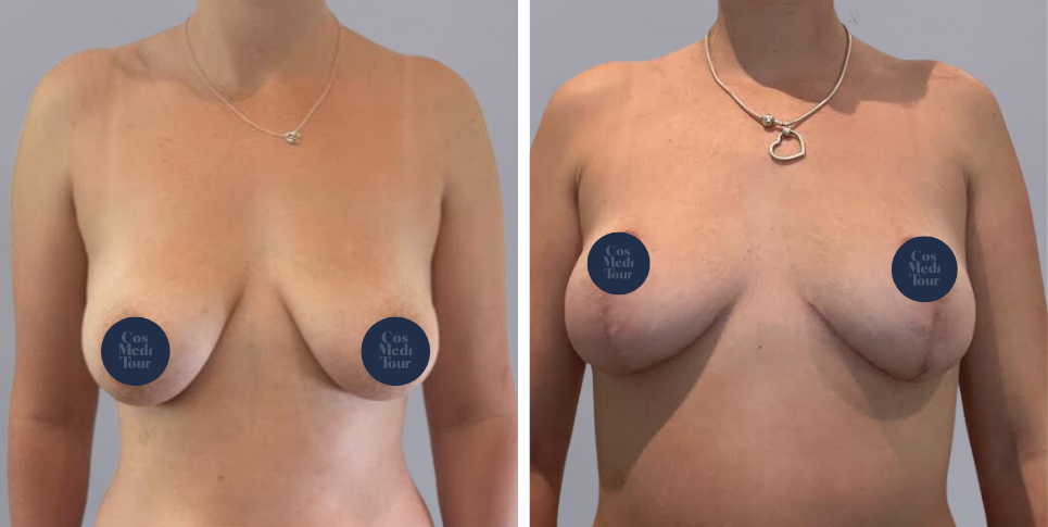 Breast Lift boob job before and after photo
