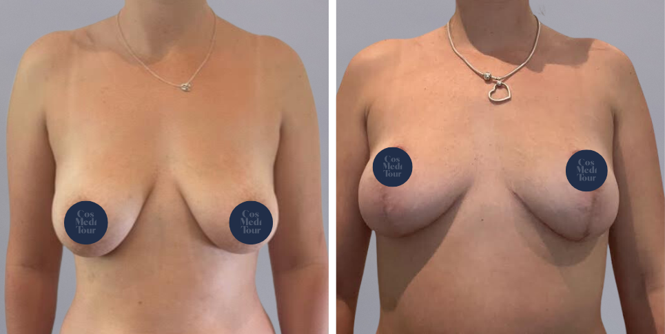 Breast Lift boob job before and after photo