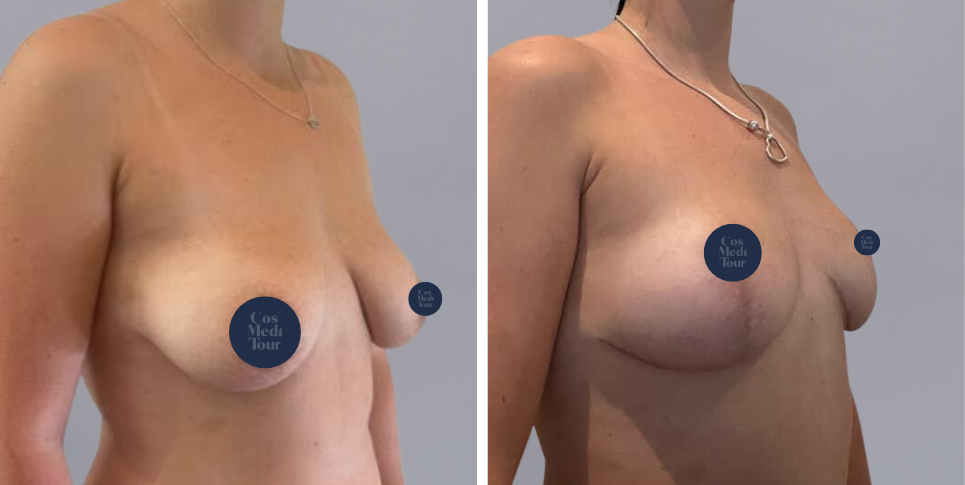 Breast Lift boob job before and after photo
