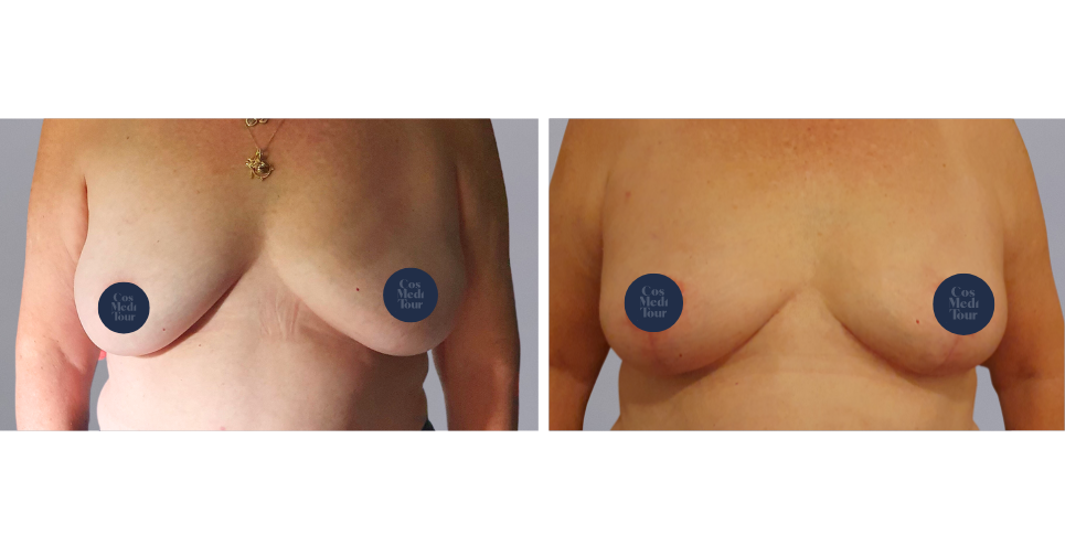 Breast Lift boob job before and after photo<br />
