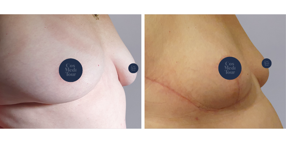 Breast Lift boob job before and after photo<br />
