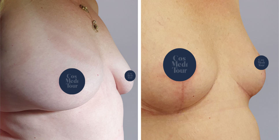 Breast Lift boob job before and after photo