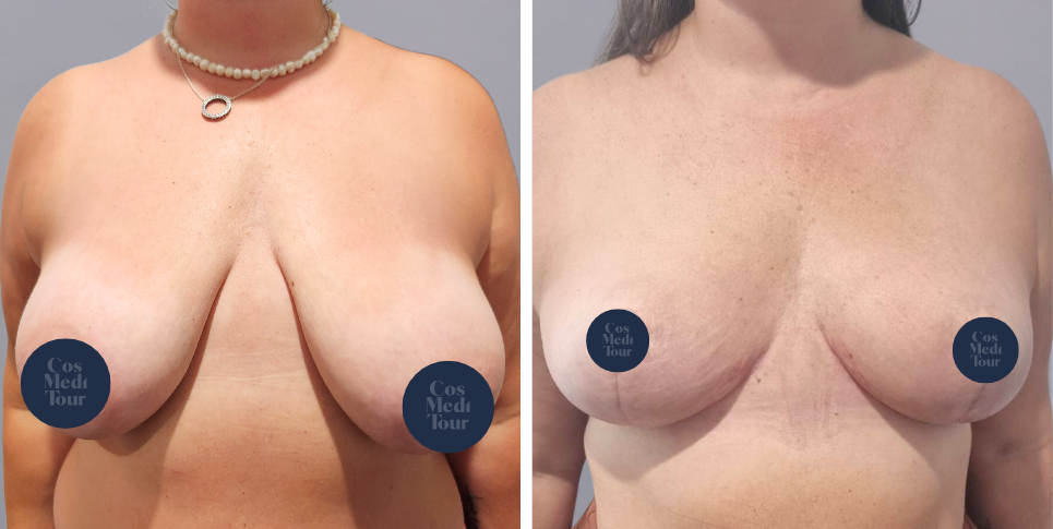 Breast Lift boob job before and after photo
