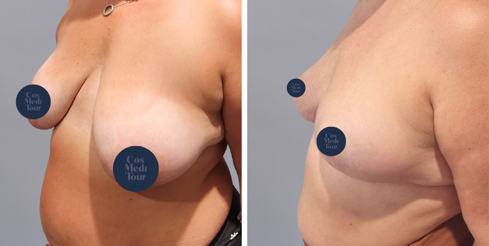 Breast Lift boob job before and after photo
