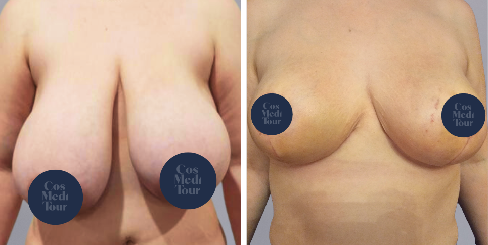 Breast Reduction boob job before and after photo
