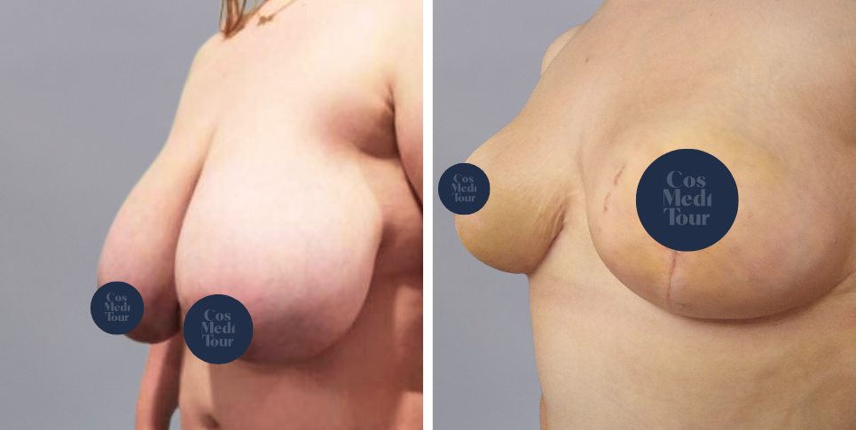 Breast Reduction boob job before and after photo
