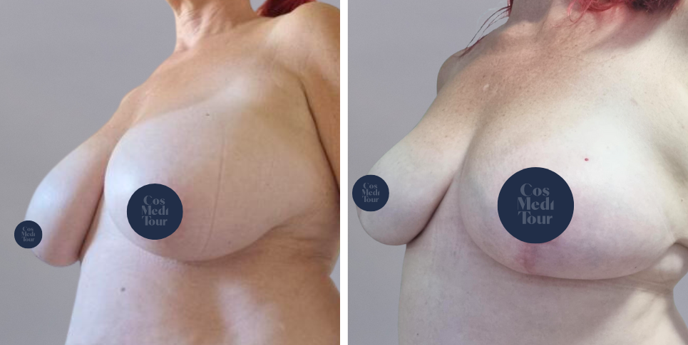 Breast Reduction boob job before and after photo
