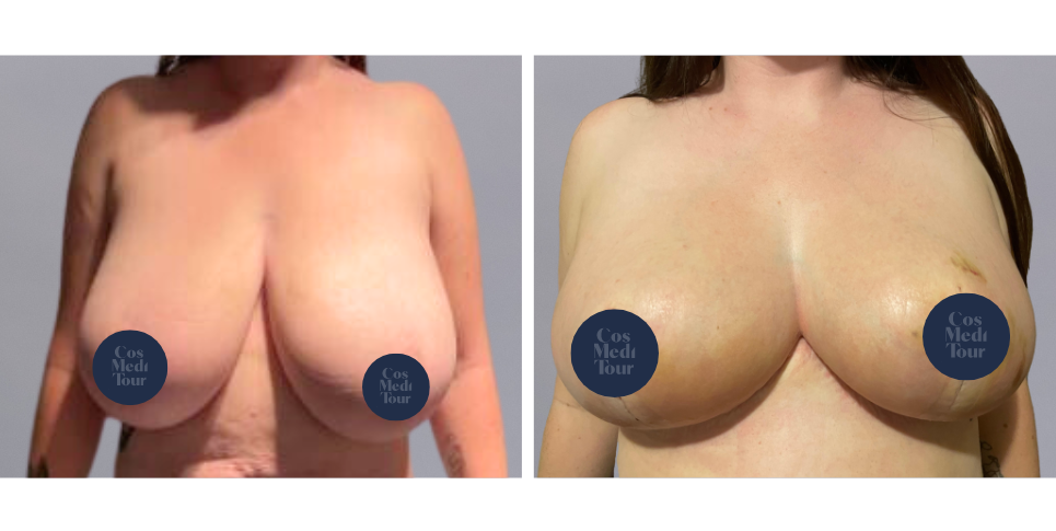 Breast Reduction boob job before and after photo