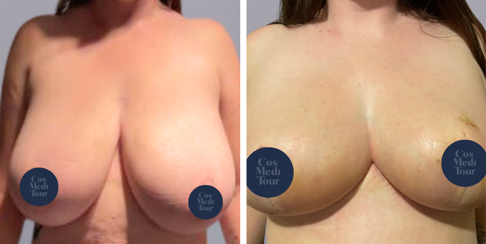 Breast Reduction boob job before and after photo