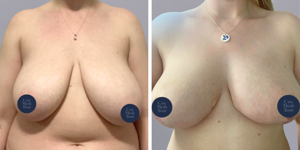 Breast Reduction boob job before and after photo