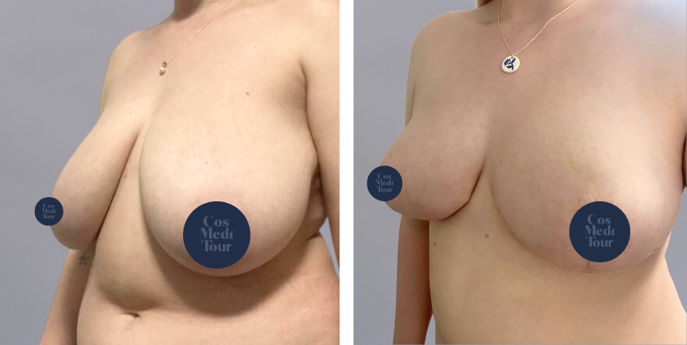 Breast Reduction boob job before and after photo