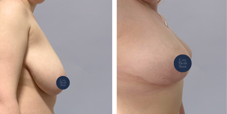 Breast Reduction boob job before and after photo