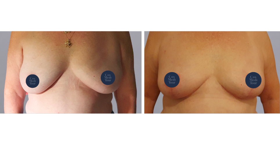 Breast Reduction boob job before and after photo