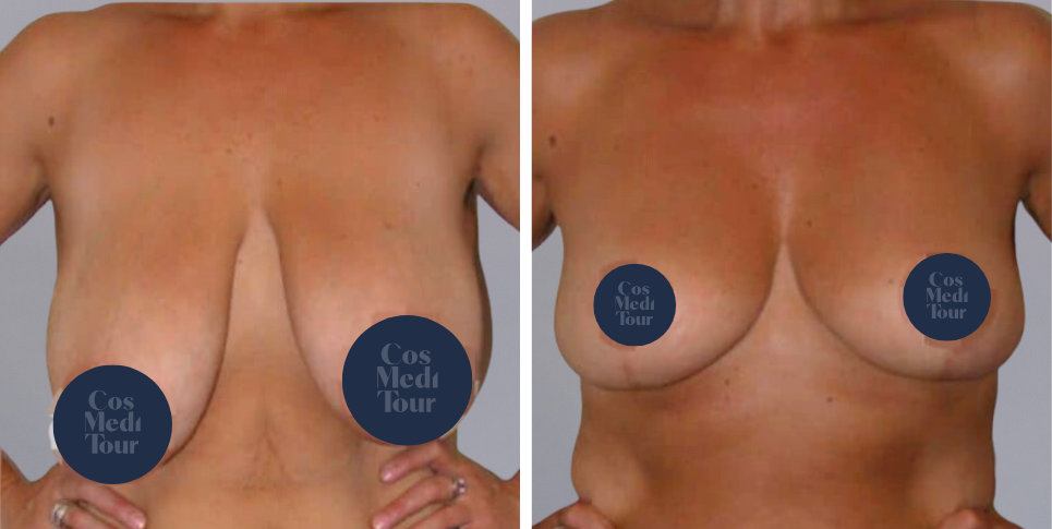 Breast Reduction boob job before and after photo
