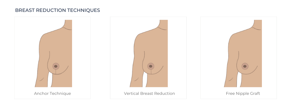 Breast Reduction Scars and Incisions