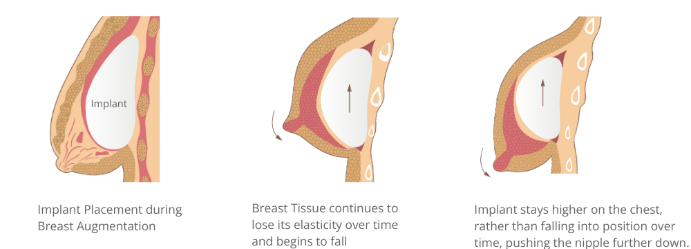 Diagram outlining how Breast Implants without a Breast Lift can cause Snoopy Deformity