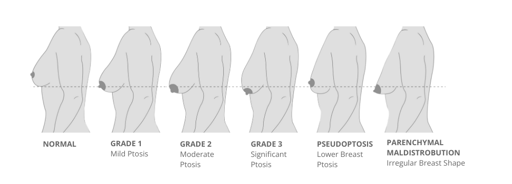 Diagram showing level of Breast Ptosis, also known as Breast Sagging, which determines whether a Breast Lift is Needed