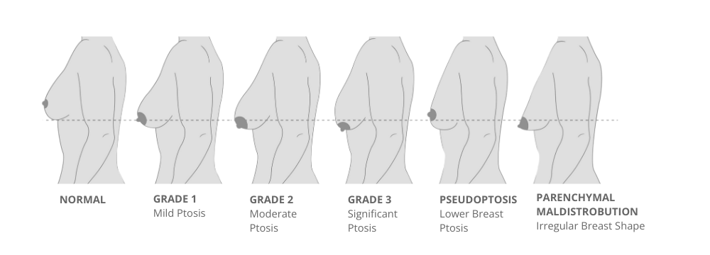 Breast Lift with Implants, Why is it Required?