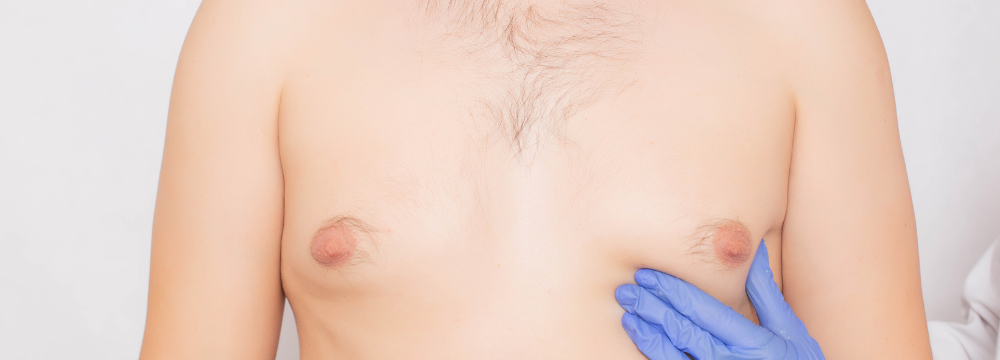 Man with Gynecomastia being assessed for Male Breast Reduction Surgery in Australia to remove Man Boobs