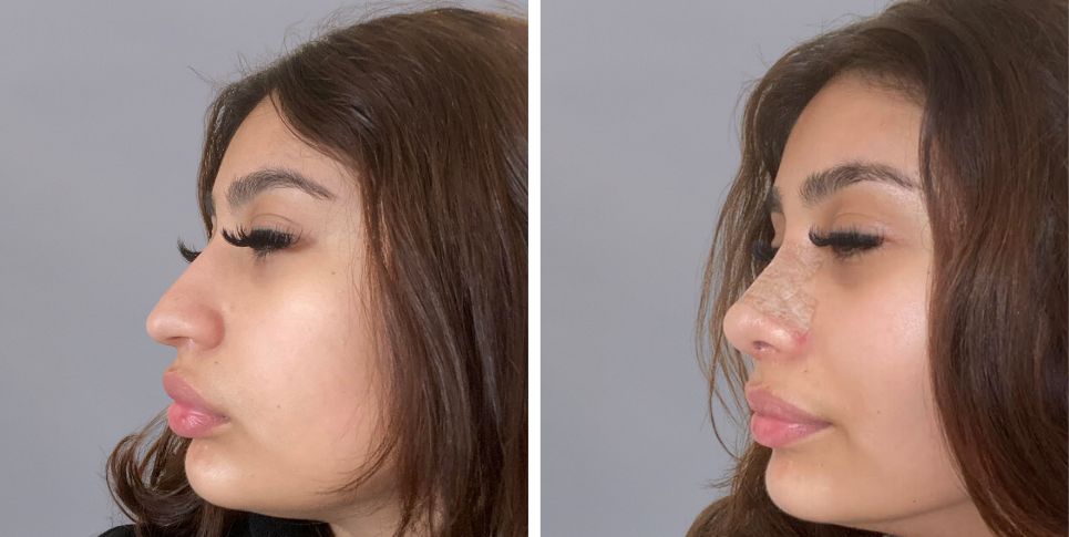 Rhinoplasty nose job before and after photo