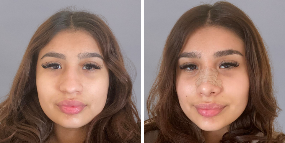 Rhinoplasty nose job before and after photo