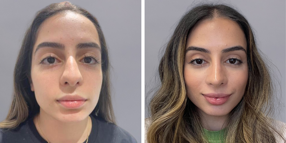 Rhinoplasty nose job before and after photo