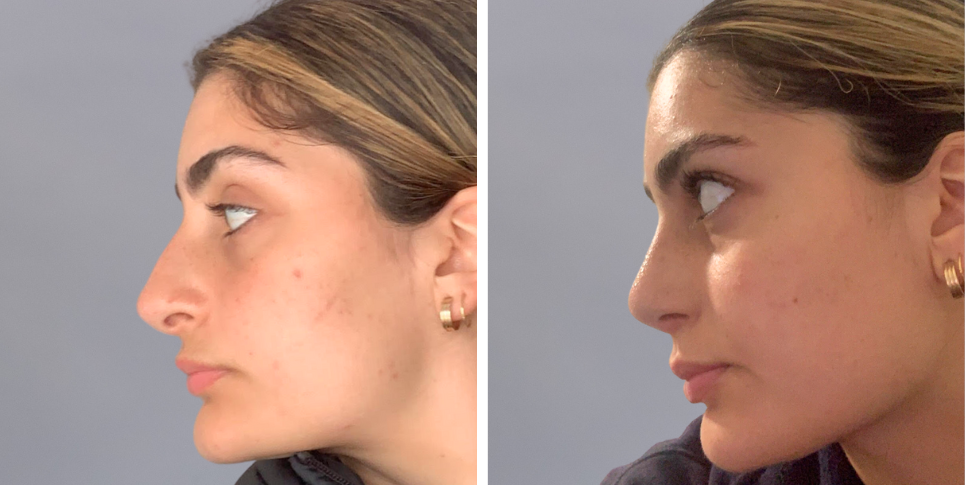 Rhinoplasty nose job before and after photo