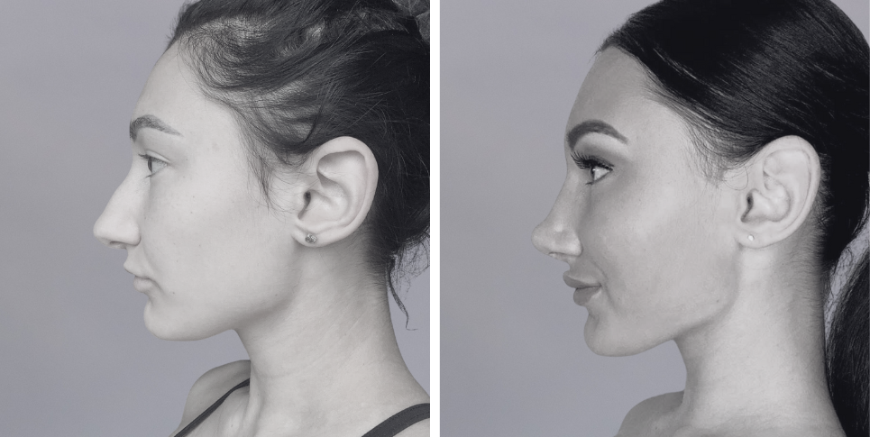 Rhinoplasty nose job before and after photo