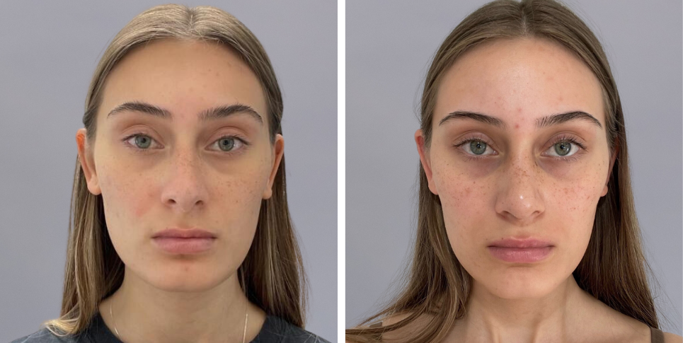 Rhinoplasty nose job before and after photo